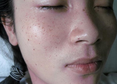 Hình ảnh da bị tàn nhang